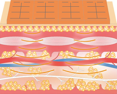 NARL517 リポスティムフィットを当てた部位の断面図